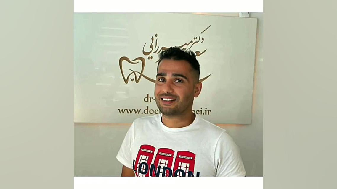 ‌لمینت VIP و استفاده از لمینت و زیرکونیا عصب کشی دو دندان ترمیم لبخند لثه‌ای