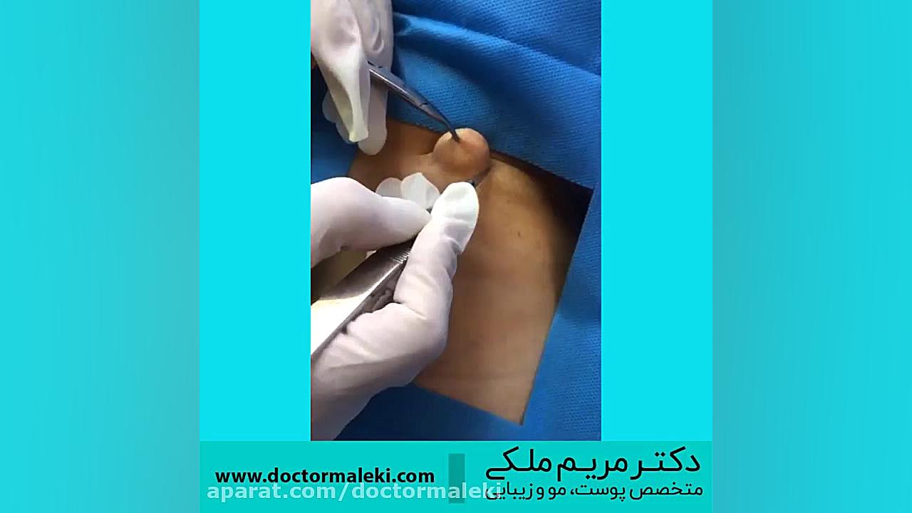 جراحی کیست دکتر مریم ملکی - کلینیک پوست و مو و زیبایی هور