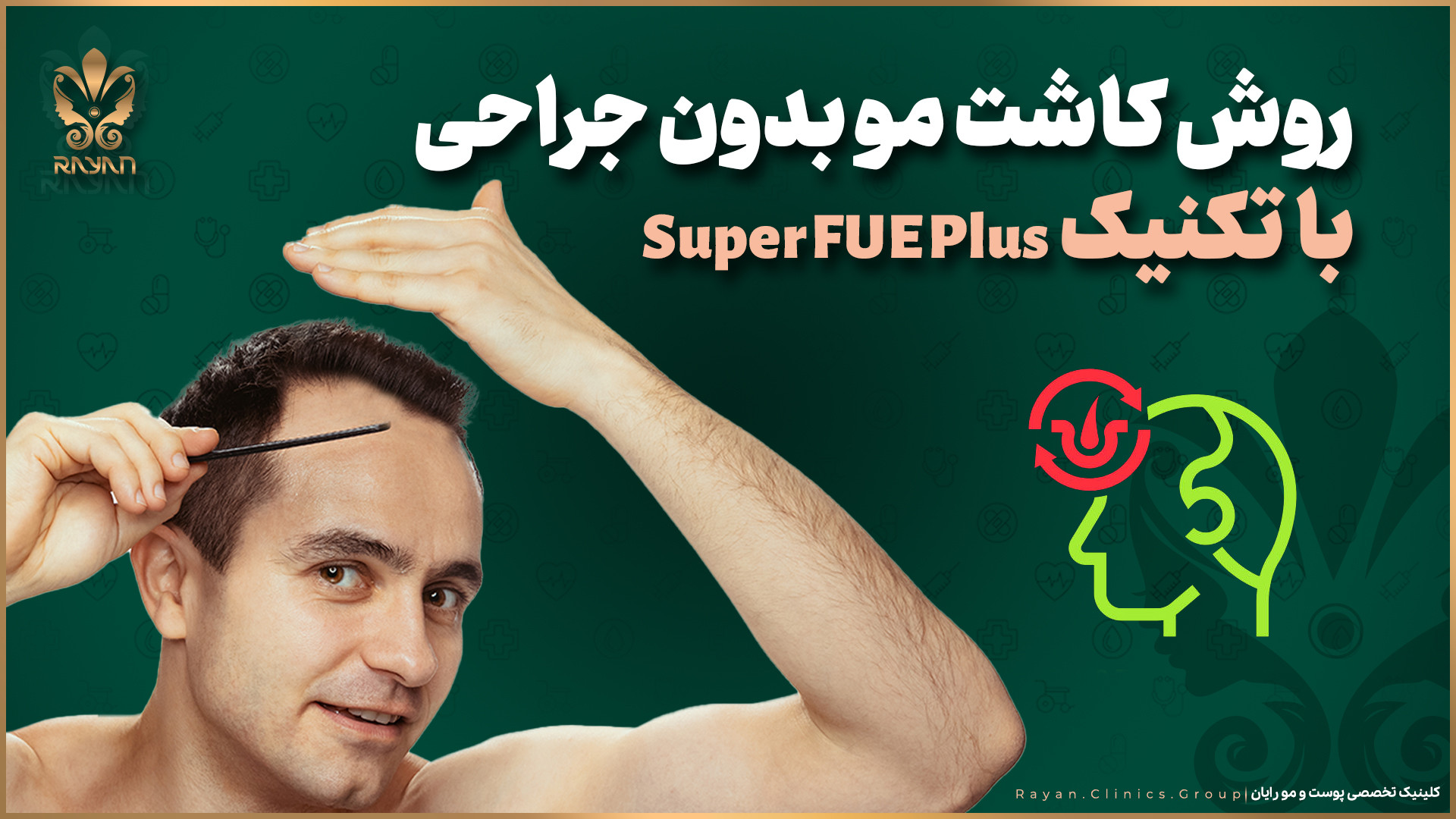 روش بدون جراحی کاشت مو با تکنیک superfue plus برداشتن خال