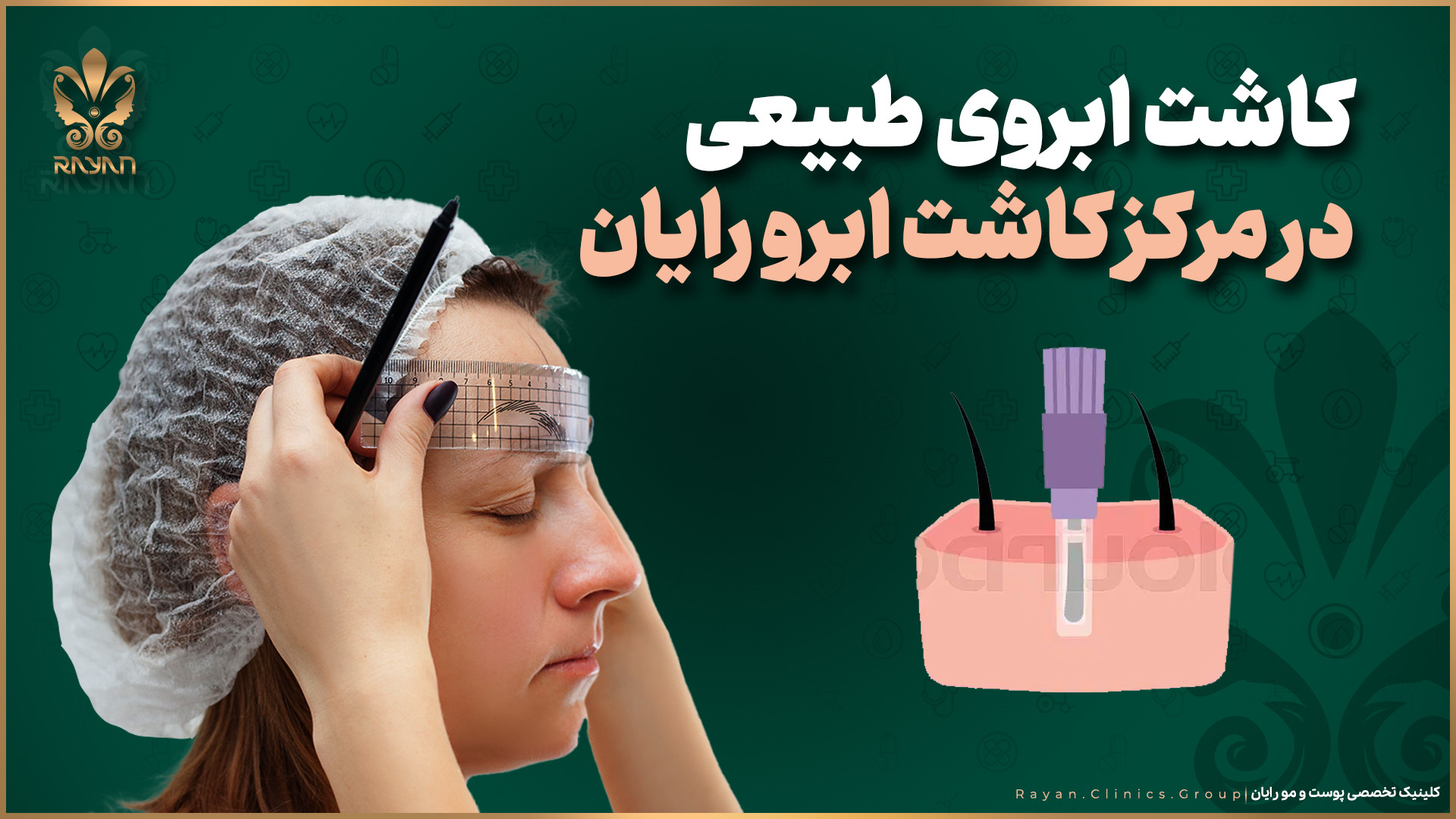 کاشت ابروی طبیعی در مرکز کاشت ابرو رایان جراحی بینی
