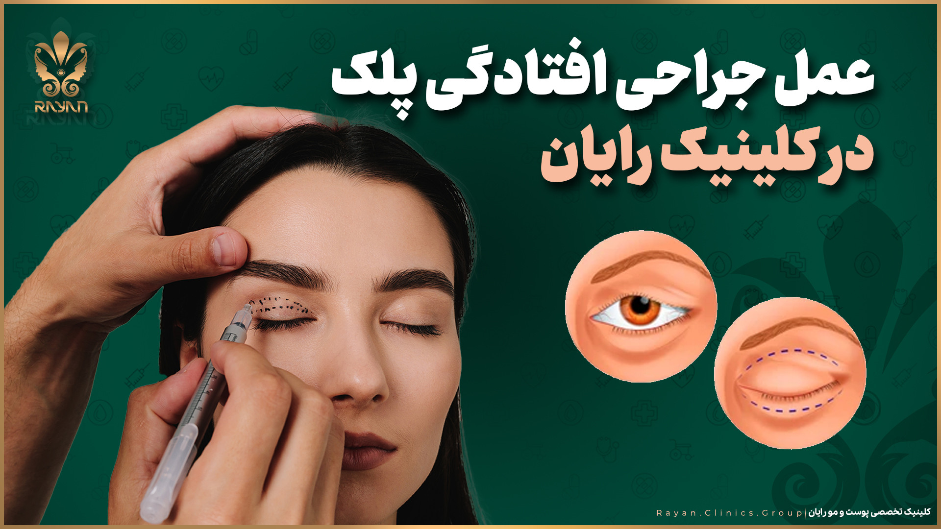 عمل جراحی زیبایی پلک بالا در کلینیک رایان سلامت ANA