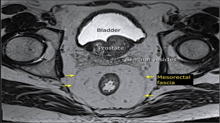 نقش MRI در مرحله بندی سرطان رکتوم دکتر احمد مافی (انکولوژیست)