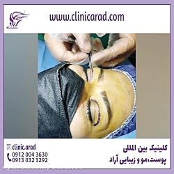 جراحی افتادگی پلک در اصفهان
