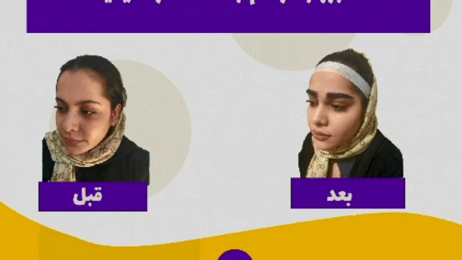 کاشت ابرو با تراکم بالا در کلینیک لاله تهران اوتیلومیومبر