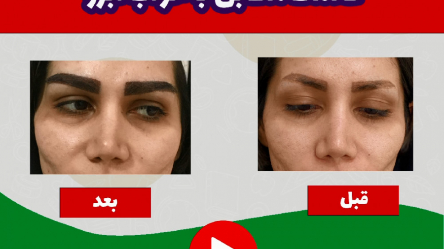 کاشت ابرو ظریف و زیبا در کلینیک لاله بیماری شوگرن