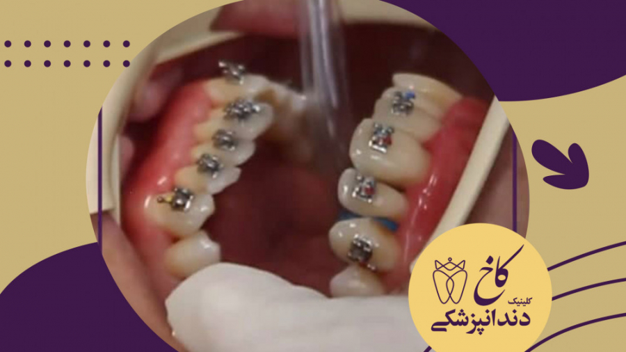 ارتودنسی اقساطی در کلینیک دندانپزشکی کاخ کلینیک دندانپزشکی کاخ