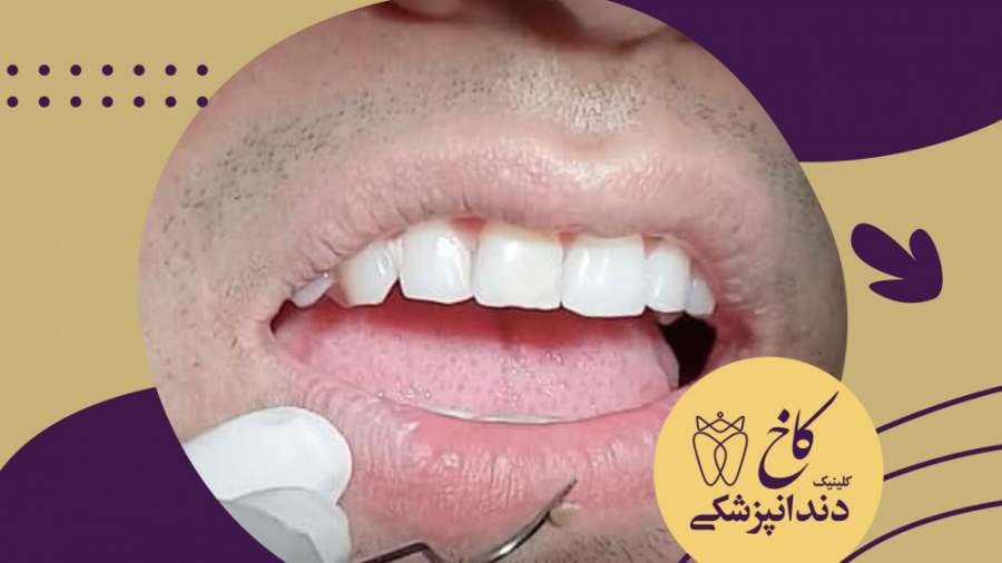 جرم گیری به روایت تصویر کلینیک دندانپزشکی کاخ
