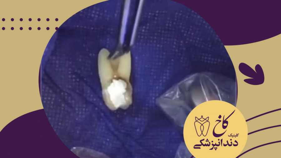 یکی از دلایل کشیدن دندان کلینیک دندانپزشکی کاخ