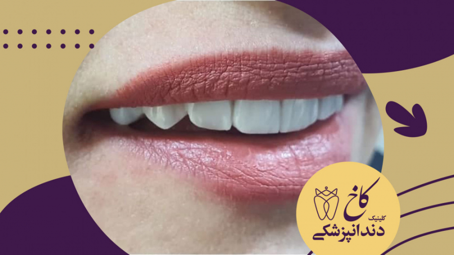 اصلاح طرح لبخند در کلینیک کاخ مشهد کلینیک دندانپزشکی کاخ