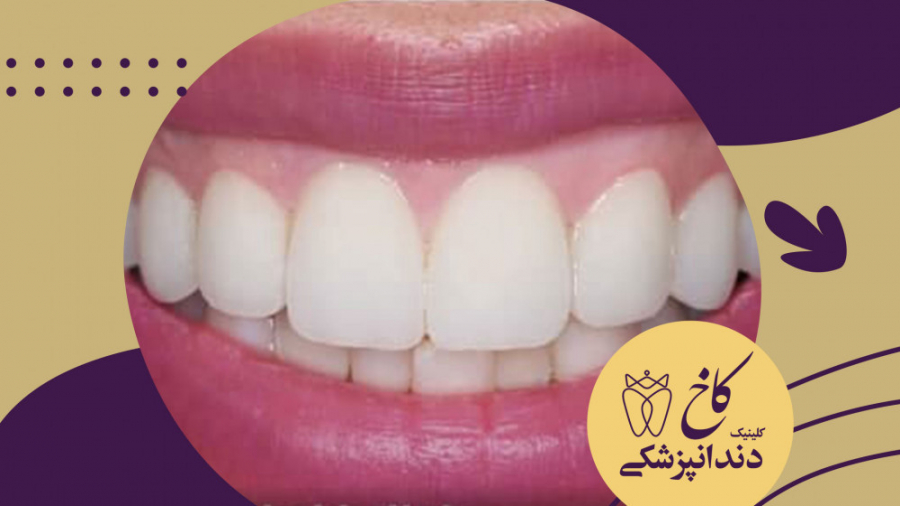 لیفت لثه، لامینیت پرسلن و بلیچینگ کلینیک دندانپزشکی کاخ