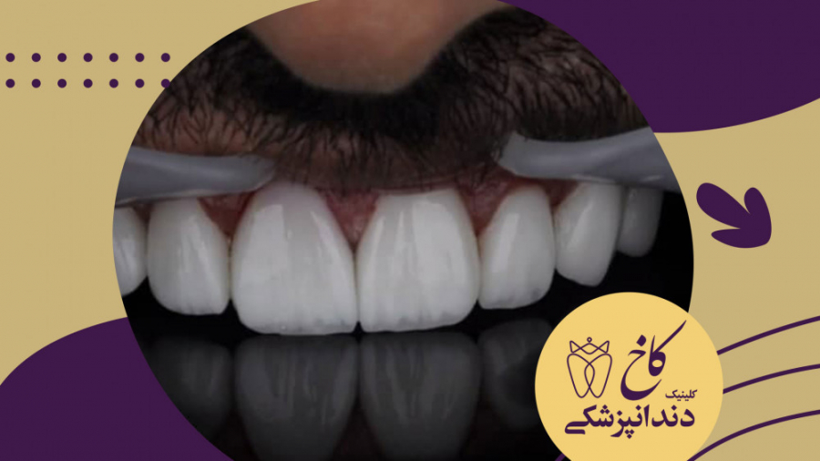 لامینیت پرسلن دندان کلینیک دندانپزشکی کاخ