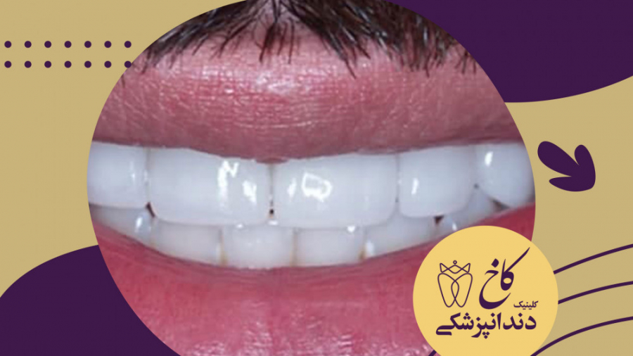 اصلاح لبخند با لامینیت دندان کلینیک دندانپزشکی کاخ