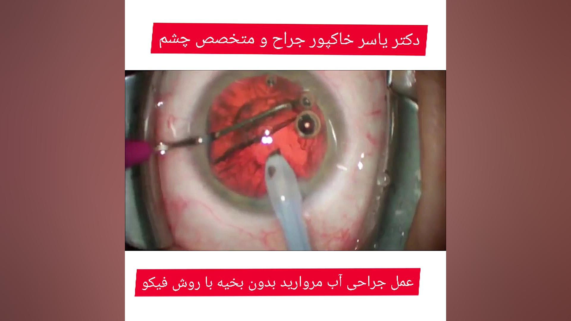 فیلم عمل جراحی آب مروارید دکتر یاسر خاکپور جراح و متخصص چشم پروتز سینه