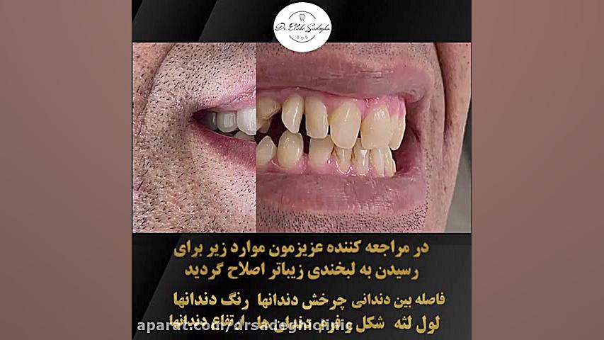 اصلاح طرح لبخند با لمینت سرامیکی _ طراحی لبخند در زعفرانیه منافذ باز پوست