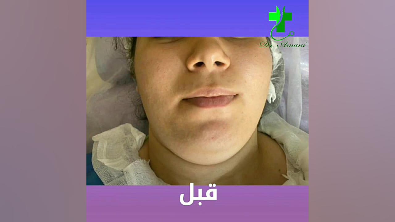 . لیپوساکشن غبغب و تخلیه بوکال پوشش زخم هیدروکلوییدی