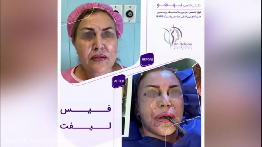 فیلم جراحی لیفت صورت در اتاق عمل دکتر شاهین بهجو - فوق تخصص جراحی پلاستیک