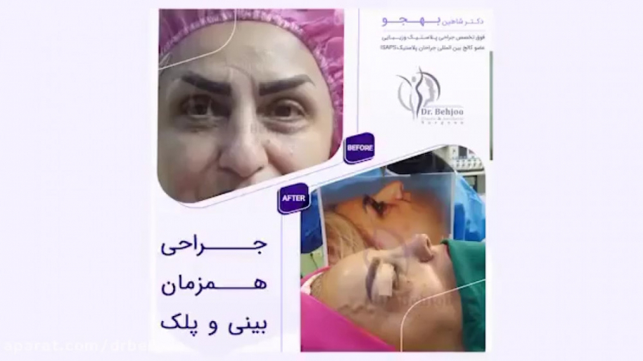 فیلم جراحی همزمان بینی و پلک، از قبل تا بعد عمل دکتر شاهین بهجو - فوق تخصص جراحی پلاستیک