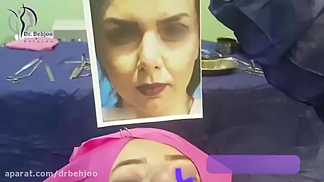 فیلم واقعی جراحی ترمیم بینی دکتر شاهین بهجو - فوق تخصص جراحی پلاستیک