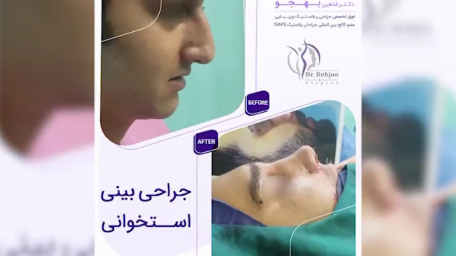 ویدئوی جراحی بینی مردانه استخوانی دکتر شاهین بهجو - فوق تخصص جراحی پلاستیک