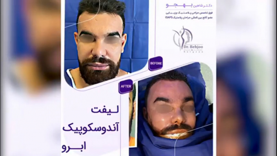 فیلم واقعی لیفت ابرو با آندوسکوپی دکتر شاهین بهجو - فوق تخصص جراحی پلاستیک