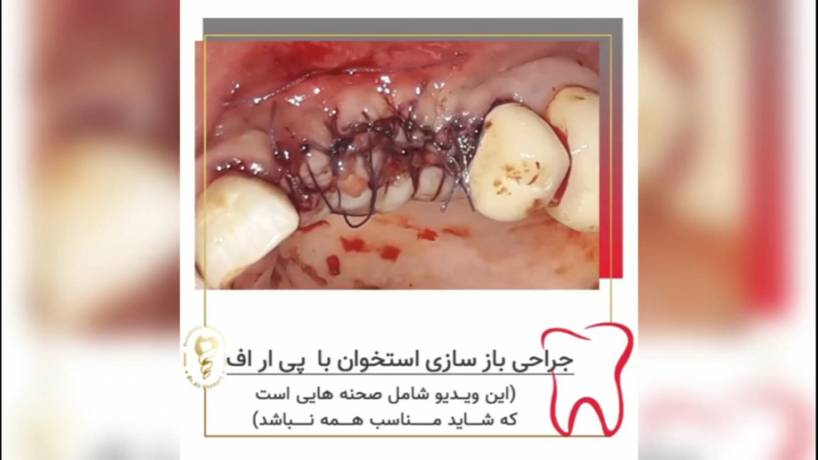 فیلم جراحی بازسازی استخوان با پی آر اف دکتر علی قمری - متخصص جراحی لثه و ایمپلنت