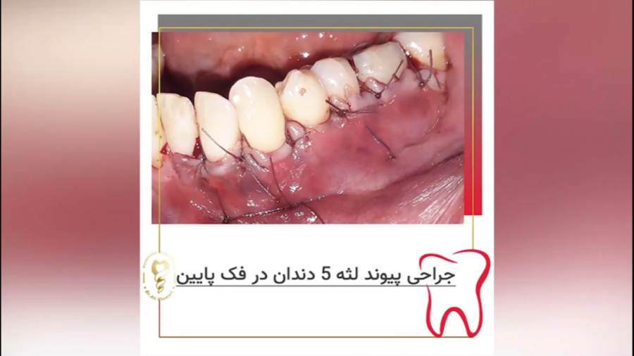 فیلم جراحی پیوند لثه ۵ دندان در فک پایین دکتر علی قمری - متخصص جراحی لثه و ایمپلنت