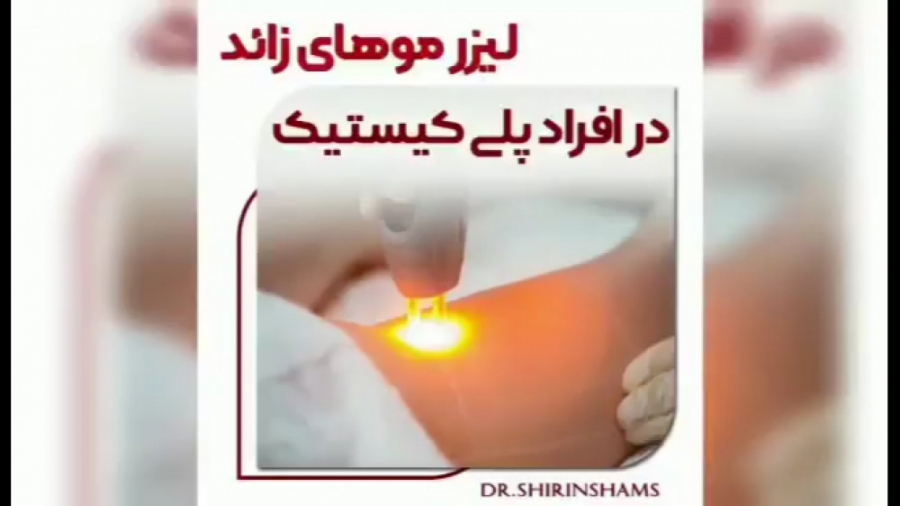 تاثیر لیزر موهای زائد در افراد پلی کیستیک دکتر شیرین شمس جراح و متخصص زنان و زایمان