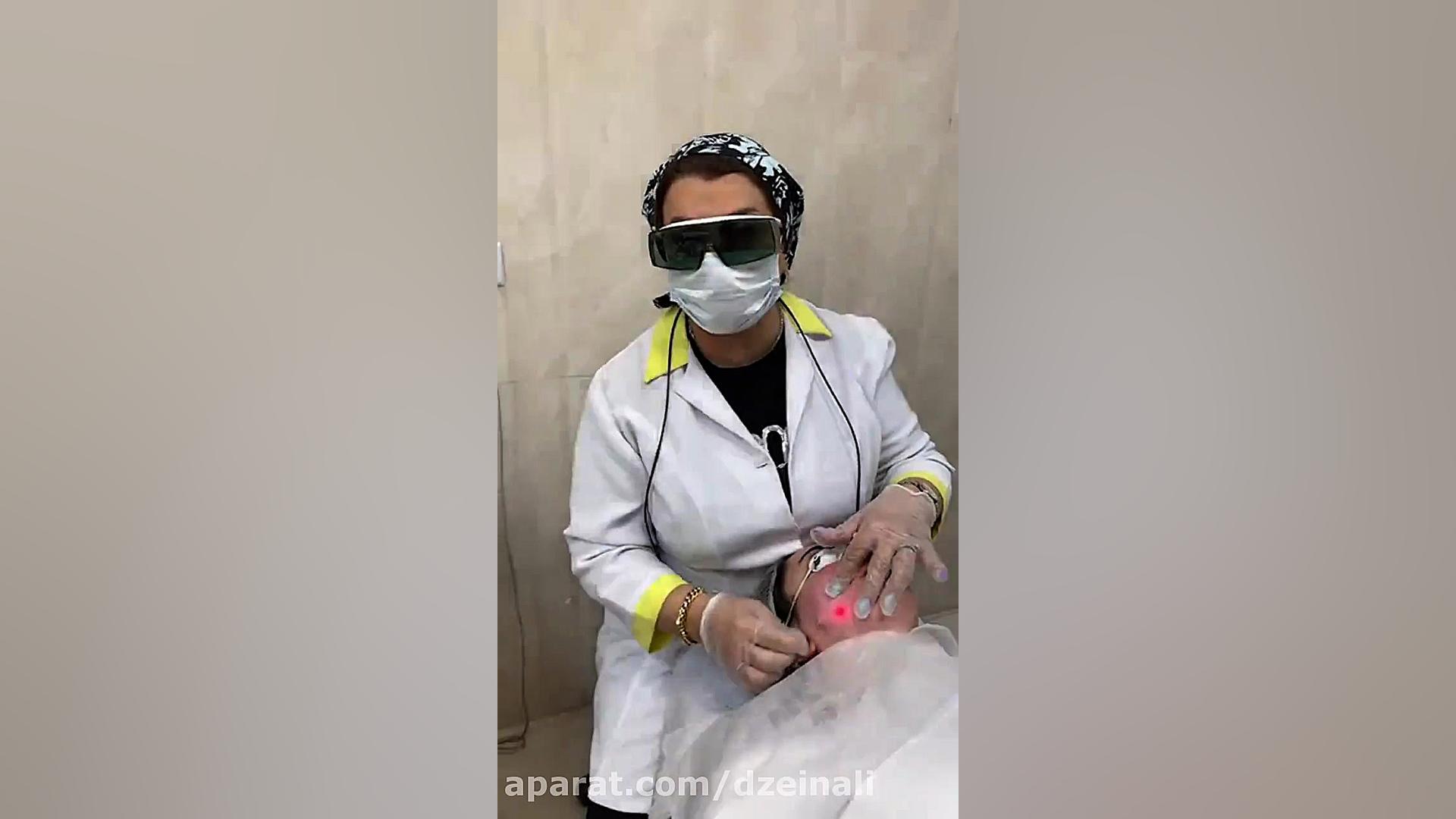 اندولیفت برای لیفت صورت و زاویه فک برای مراجعه کننده فرانسوی Microarray