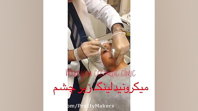 رفع تیرگی زیر چشم با روش میکرونیدلینگ FVC