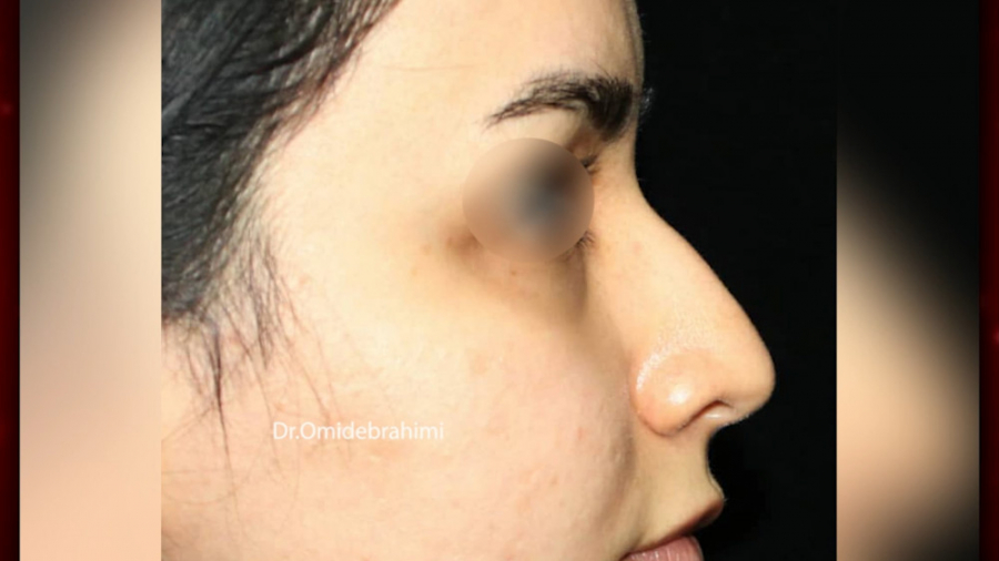 جراحی زیبایی بینی توسط دکتر امید ابراهیمی بهترین جراح بینی در تهران دکتر امید ابراهیمی