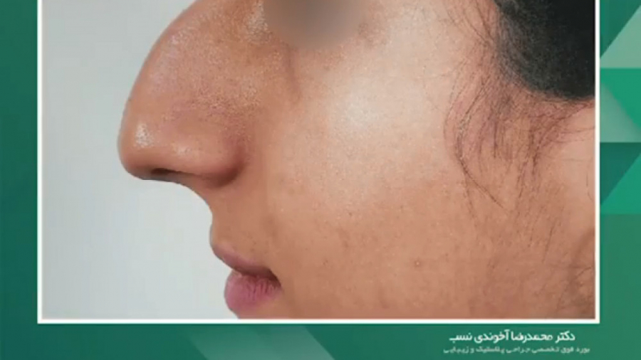 عمل بینی استخوانی دکتر محمدرضا آخوندی نسب-فوق تخصص جراحی پلاستیک
