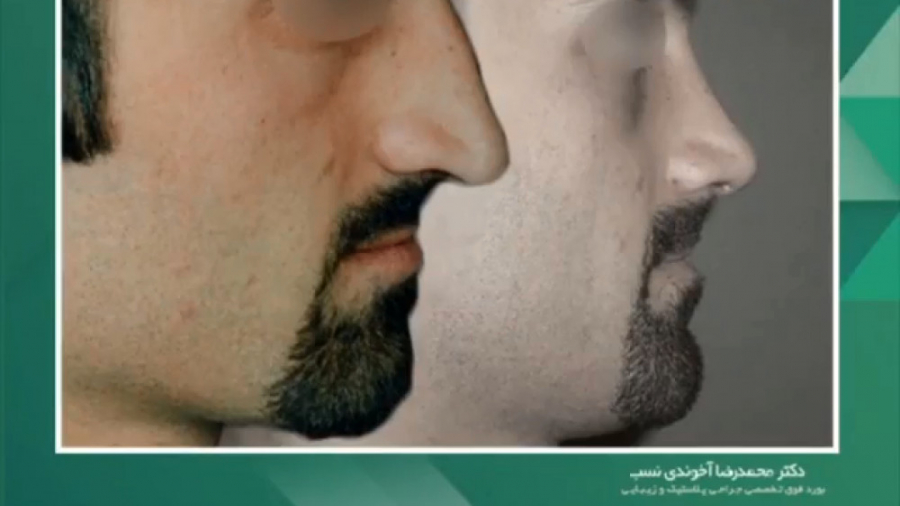 جراحی بینی استخوانی در مردان دکتر محمدرضا آخوندی نسب-فوق تخصص جراحی پلاستیک