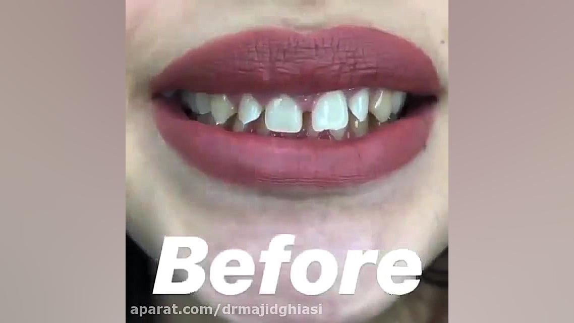 اصلاح طرح لبخند دکترمجیدقیاسی