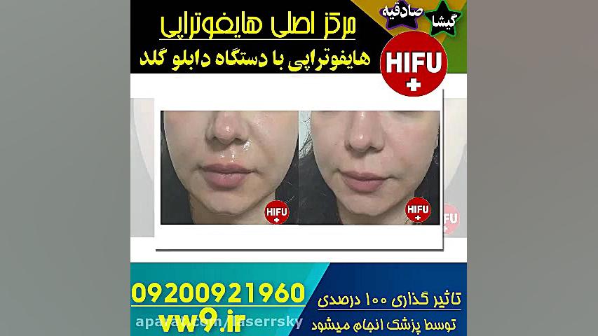 هایفوتراپی ایوانبرادین