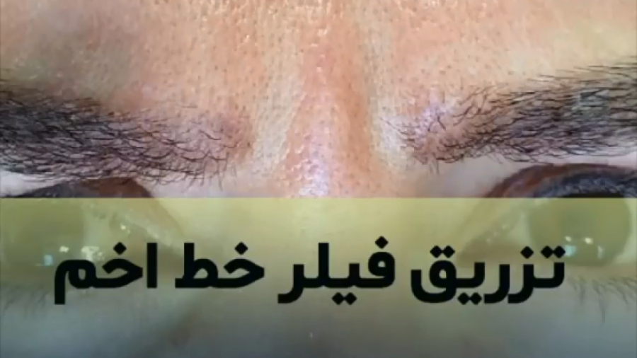 تزریق فیلر خط خنده دکتر ایمان روغنی جراح و متخصص پوست و مو
