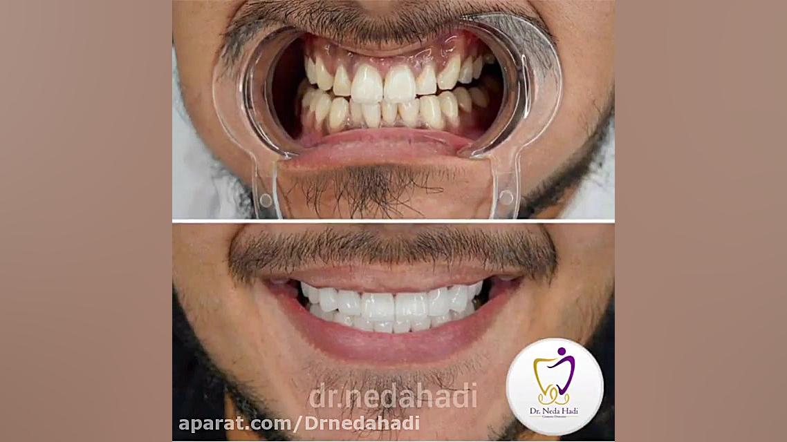 فیلم لمینت دندان دکتر ندا هادی-دندانپزشک زیبایی