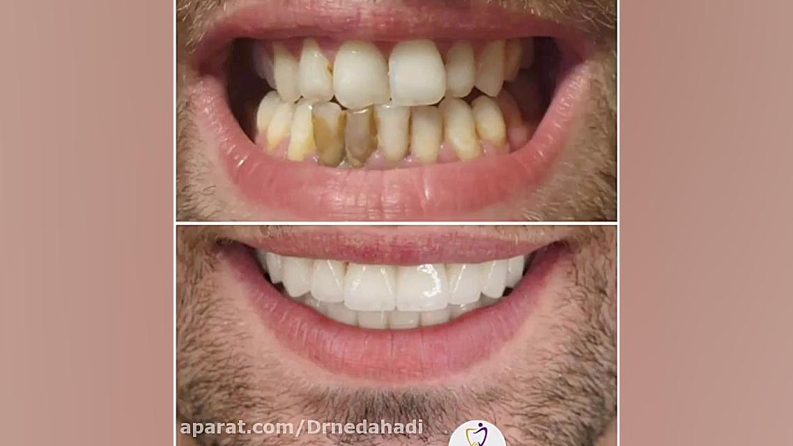 معجزه لبخند زیبا با لمینت دندان دکتر ندا هادی-دندانپزشک زیبایی