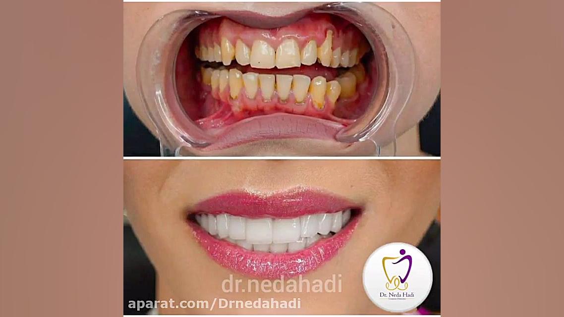 خدمات تخصصی ترمیمی و زیبایی دندان دکتر ندا هادی-دندانپزشک زیبایی
