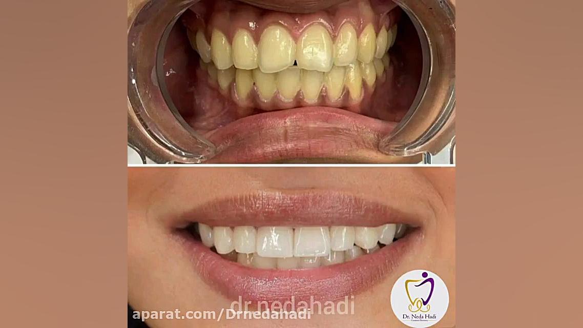 کامپوزیت دندان، معجزه زیبایی دکتر ندا هادی-دندانپزشک زیبایی