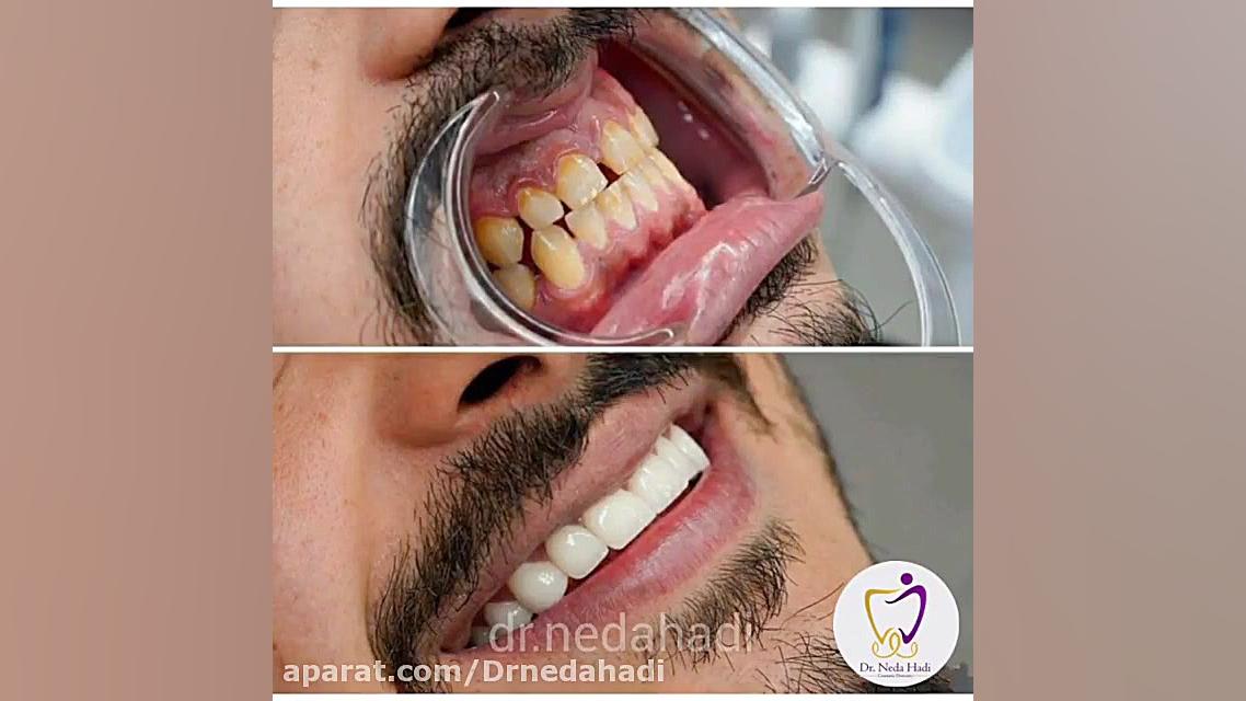 نمونه کار بسیار زیبای لمینت دندان دکتر ندا هادی-دندانپزشک زیبایی