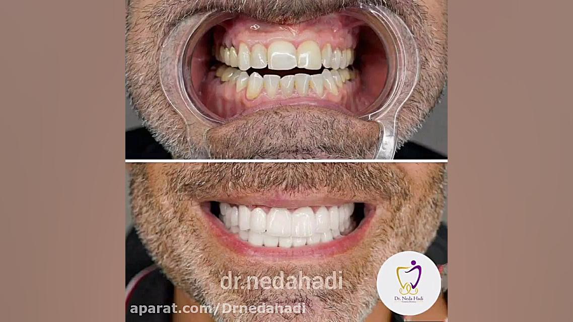 با لمینت، لبخند خود را زیباتر کنید دکتر ندا هادی-دندانپزشک زیبایی