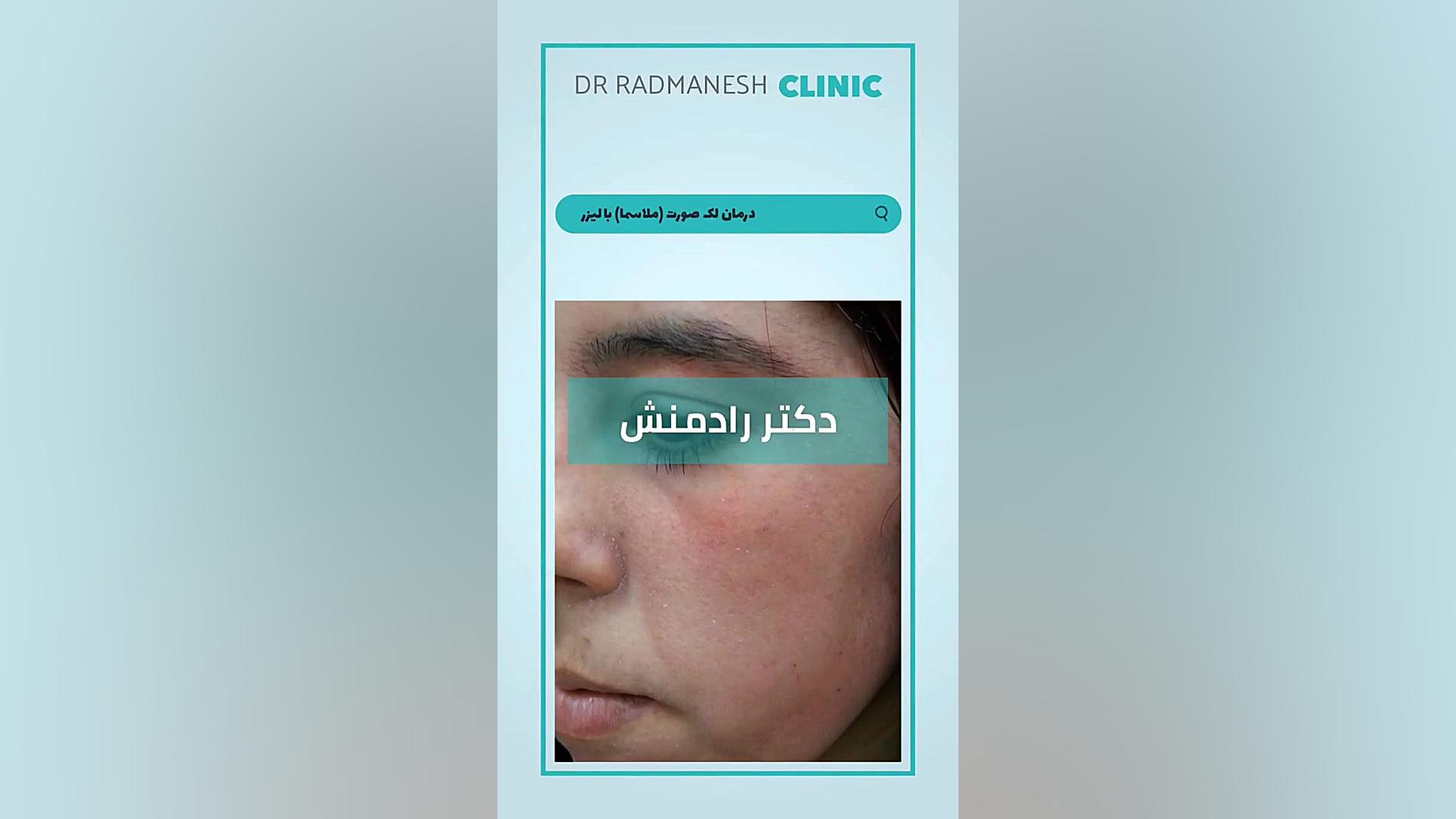 درمان لک صورت (ملاسما) با لیزر بلیچینگ