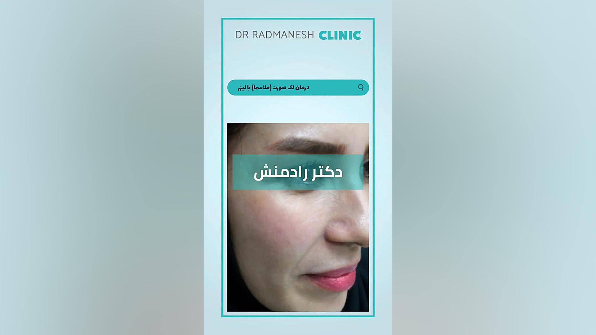 درمان لک صورت (ملاسما) با لیزر برداشتن زگیل