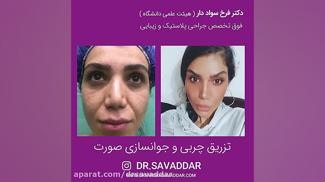 تزریق چربی جوان سازی صورت دکتر فرخ سواددار