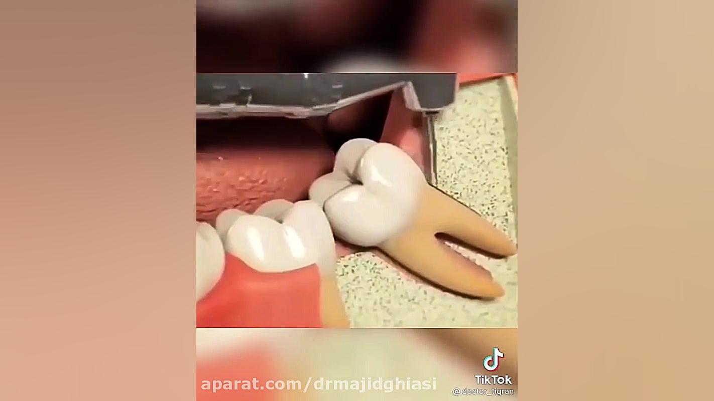 جراحی دندان عقل نیمه نهفته دکترمجیدقیاسی