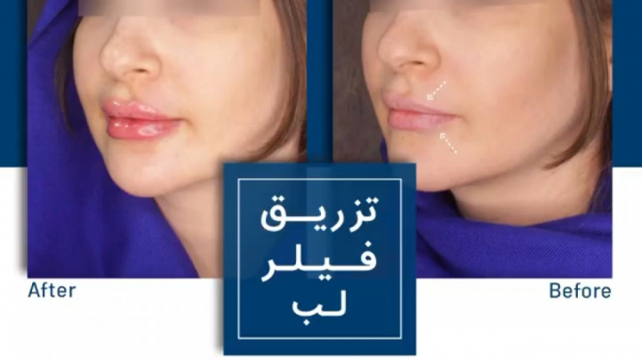 تزریق فیلر لب ارتودنسی