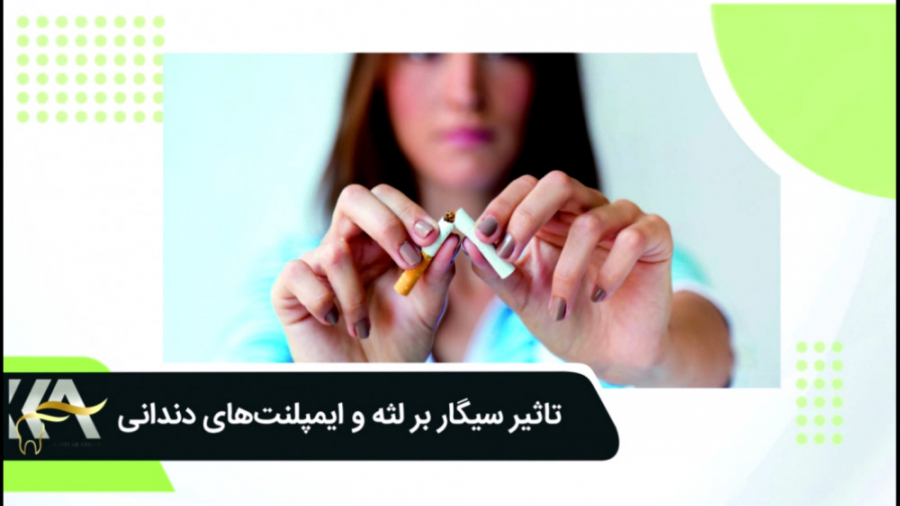 تاثیر سیگار بر لثه و ایمپلنت های دندانی دکتر کامیار عباسی
