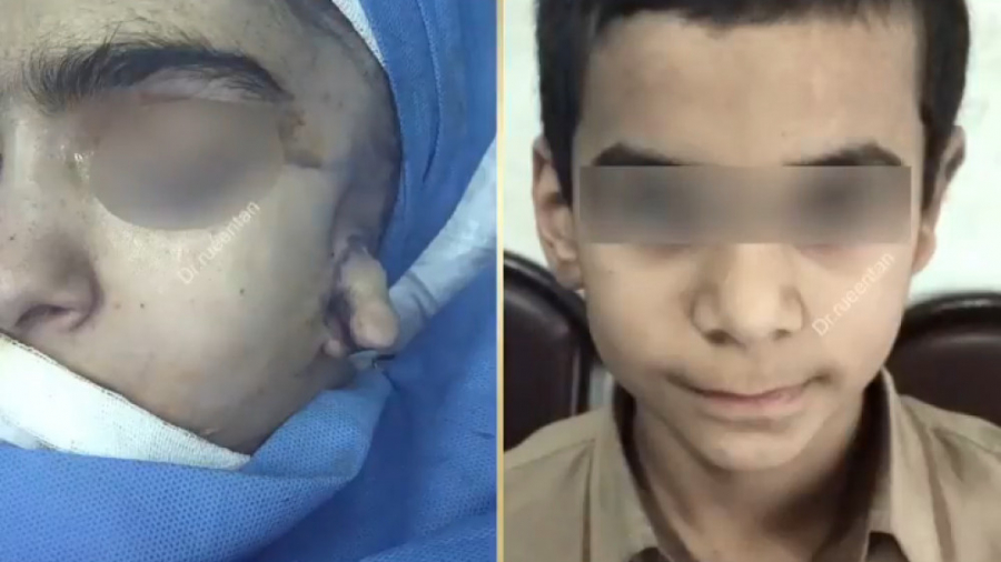جراحی بازسازی گوش با غضروف دنده توسط دکتر عبدالرضا روئین تن دکتر عبدالرضا روئین تن