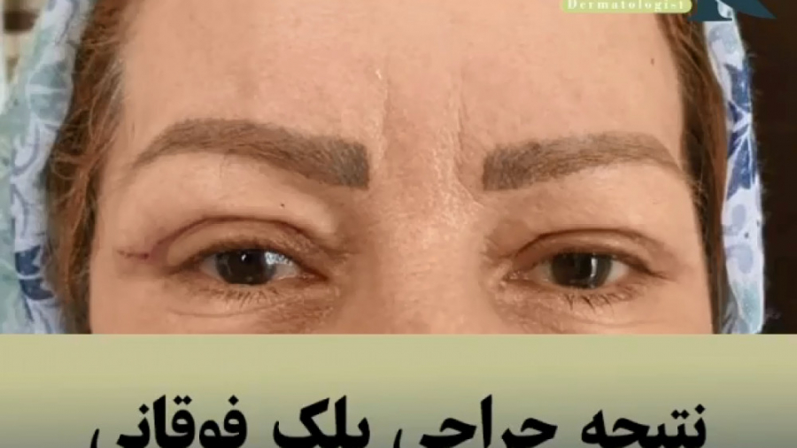 جراحی پلک دکتر ایمان روغنی جراح و متخصص پوست و مو