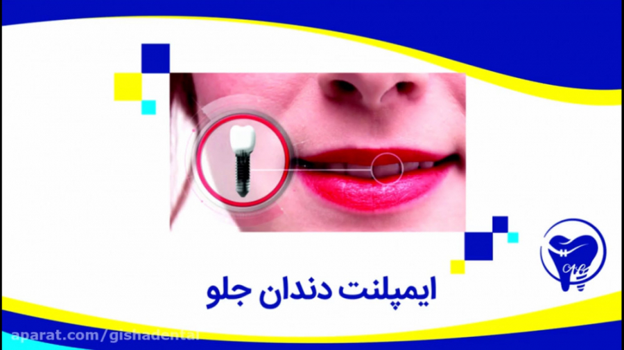 ایمپلنت دندان جلو کلینیک دندانپزشکی دکتر عزیز گشاده رو